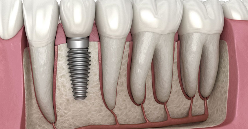 Dental Implants at Jamnagar