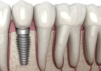 Dental Implants