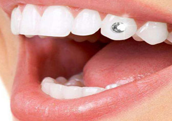 Full mouth rehabilitation