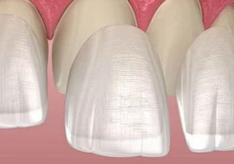 Dental Veneers
