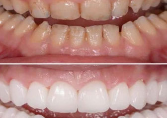 Full mouth rehabilitation