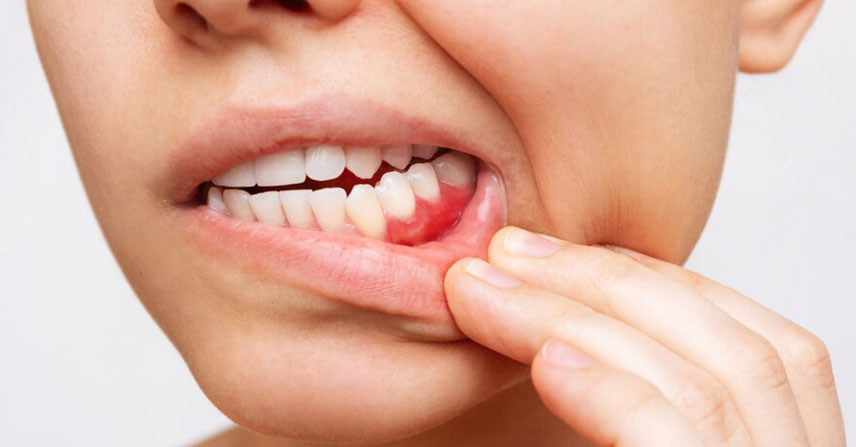 Gum Disease at Jamnagar