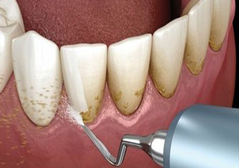 Gum Disease