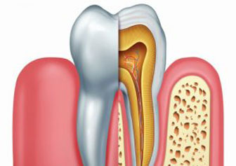 Root Canal