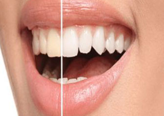 Teeth Whitening