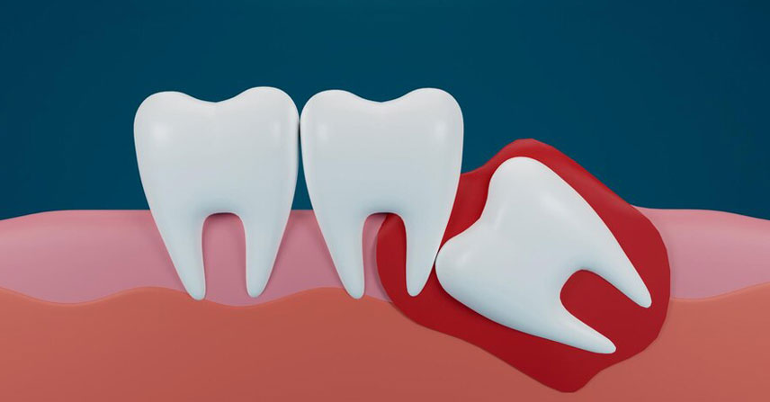 Jamnagar Dental Care Center Wisdom Tooth Removal at Jamnagar