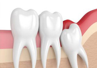 Wisdom Tooth Removal